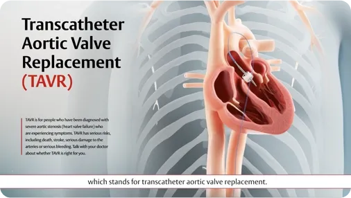 Video thumbnail: TAVR procedure