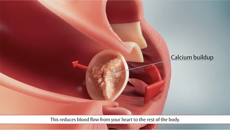 Video Thumbnail: What Is Heart Valve Failure?