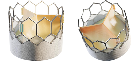 The SAPIEN 3 Ultra RESILIA valve is the latest valve approved in the SAPIEN 3 TAVR family of valves