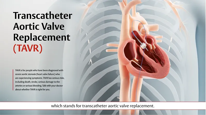 Video thumbnail Transcatheter Aortic Valve Replacement