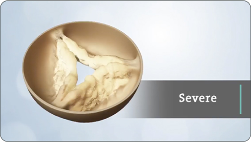 Video thumbnail: What is Heart Valve Failure