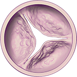 Graphic of moderate aortic stenosis