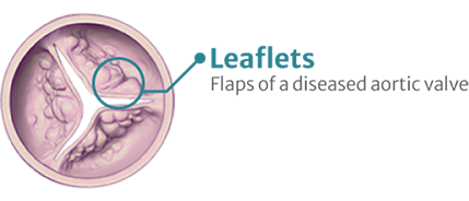 Graphic of leaflets, the flaps of the aortic valve