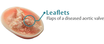 Leaflets: flaps of a diseased aortic valve