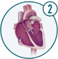 Icon of a TAVR device being placed with a medical tool