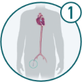 Icon of human body indicating where incision is made for TAVR procedure