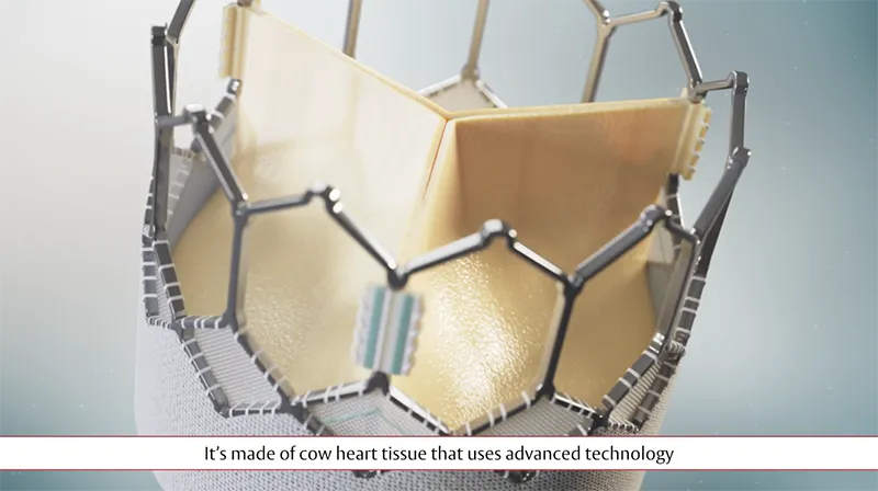 Video thumbnail Why Choose TAVR by Edwards