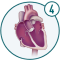 Icon of new TAVR device opening and closing