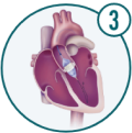 Icon showing the medical tool carrying the TAVR device to the aortic valve