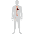Icon of human body indicating where incision is made for TAVR procedure