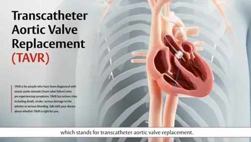 Video thumbnail: TAVR procedure