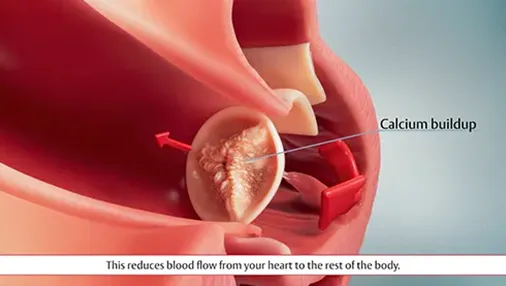 Video thumbnail: What is Heart Valve Failure