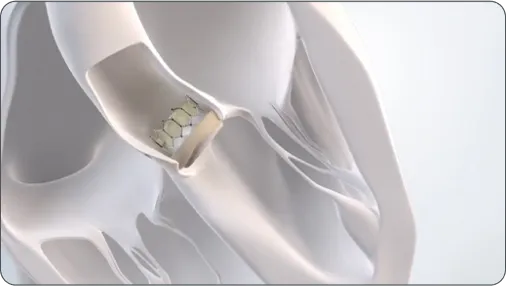 Video thumbnail: How Is TAVR Performed