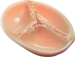 Graphic of mild aortic stenosis