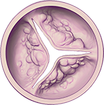 Graphic of severe aortic stenosis (heart valve failure)