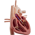 Icon of a TAVR device being placed with a medical tool
