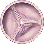 Graphic of mild aortic stenosis